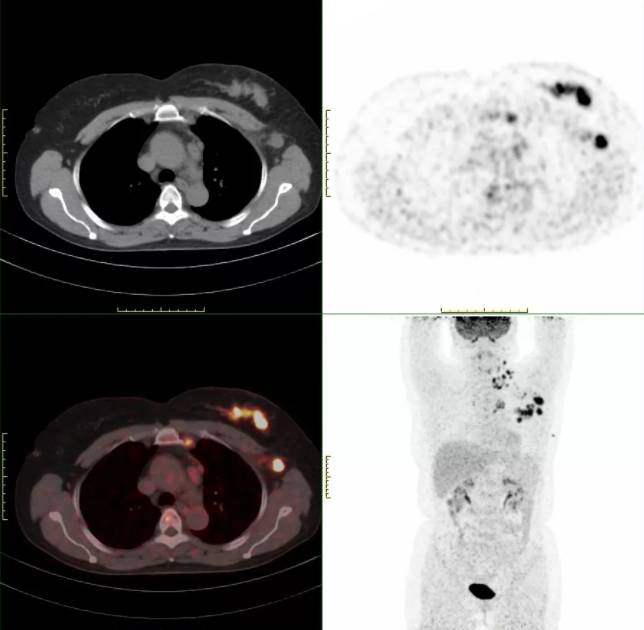 PET-CT：肿瘤检查“核”武器