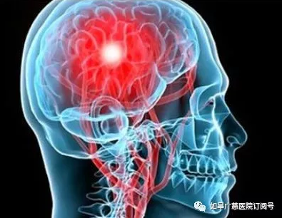 【典型病例】静脉溶栓——为急性脑梗死患者开启“生命之路”