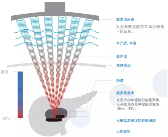 走进实体肿块（包括实体肿瘤）绿色无创治疗新时代——“海扶刀”正式落户如皋广慈医院